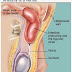 Mengobati Hernia Dengan Terapi Celana Magnetik