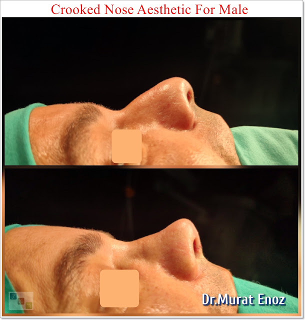 Crooked Nose Aesthetic Surgery For Male,Deviated Nose Aesthetic, Asymmetric Nose Rhinoplasty