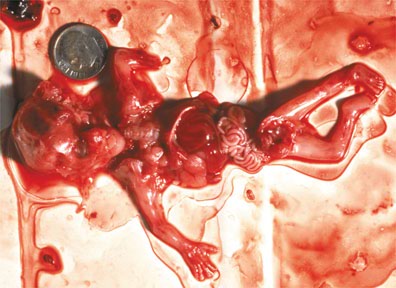 Aborto quirrgico: MedlinePlus enciclopedia mdica