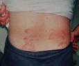 skin rash treatment