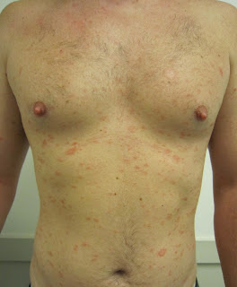 Discoid Eczema Treatment and Pictures