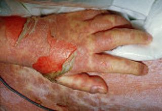 Le syndrome de Lyell (nécrolyse épidermique toxique) est un état dermatologique potentiellement létal et induit en général par un médicament, entrainant une réaction du système immunitaire mal comprise et aboutissant à la nécrose des kératinocytes (cellules de la peau) comme dans une brûlure thermique ou chimique.