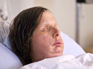 Face Transplants of Charla Nash