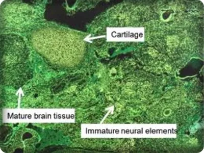 partenogenesis manusia dan teratoma ovarium: Sebuah studi tinjauan