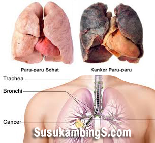 penyakit paru paru