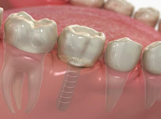 Cách chăm sóc răng Implant sau khi cấy ghép