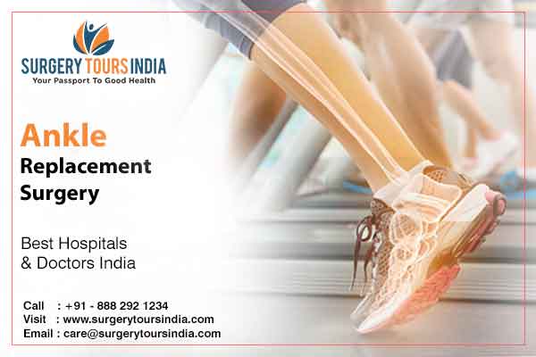 Guide to Ankle Replacement Surgery