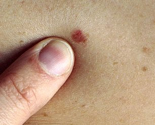 basal cell skin cancer photos