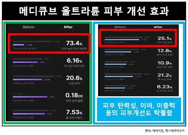 메디큐브울트라튠-피부개선효과