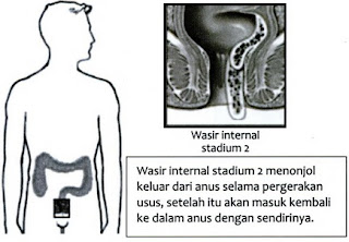 wasir terjadi lantaran beberapa faktor yang menciptakan kita berfikir untuk mencari obat ambeien  20 Obat Ambeien/Wasir Tradisional, Obati Ambeien Dengan Cara Alami 