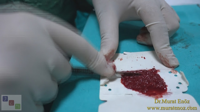 Preparation of cartilage paste during rhinoplasty operation - What is cartilage paste? - How to prepare cartilage paste? - Preparation of blood mixture with cartilage powder - How to put cartilage paste during rhinoplasty operation? - Preparation of cartilage paste with cartilage powder - Preparation of cartilage paste during rhinoplasty operation - Use of cartilage paste during cosmetic nose surgery