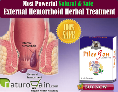 Internal Hemorrhoids Natural Treatment