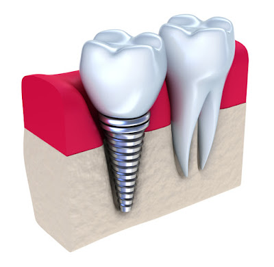 Cấy ghép trụ implant thực hiện như thế nào?