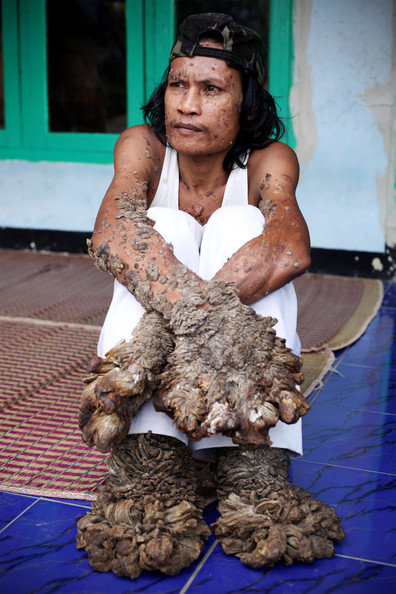 Epidermodysplasia Verruciformis- Ağaç Adam Hastalığı‏