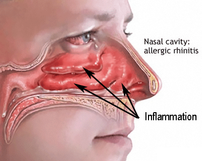  एलर्जीय राइनाइटिस - चेन्नई में आवर्ती ठंड होम्योपैथी उपचार - Allergic Rhinitis - Recurrent cold