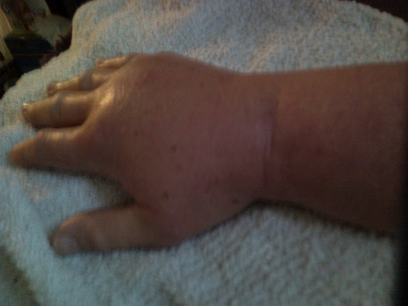 Cellulite Carrie Underwood Before After Weight Loss | How to get rid ... On Friday morning, my hand looked like this