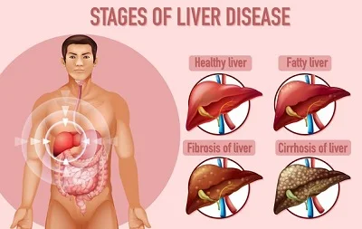 life expectancy with fatty liver disease