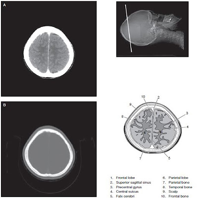 head ct scan