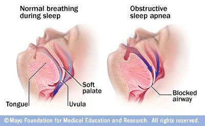 Obstructive sleep apnea