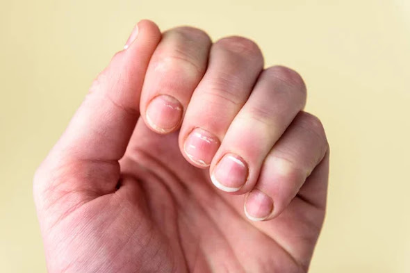 Nails showing Calcium deficiency