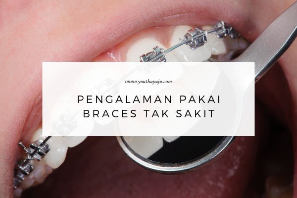 pengalaman pakai braces