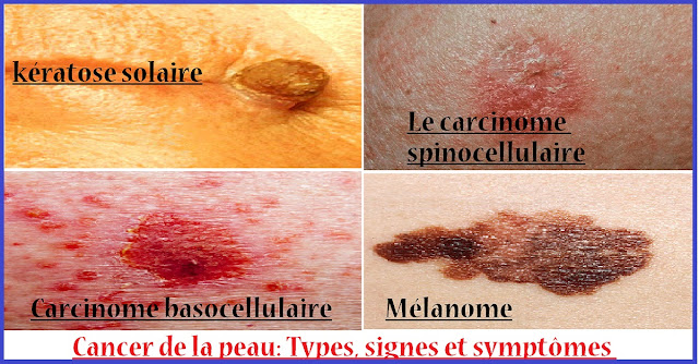 Cancer-de-peau-Types-signes-symptomes 