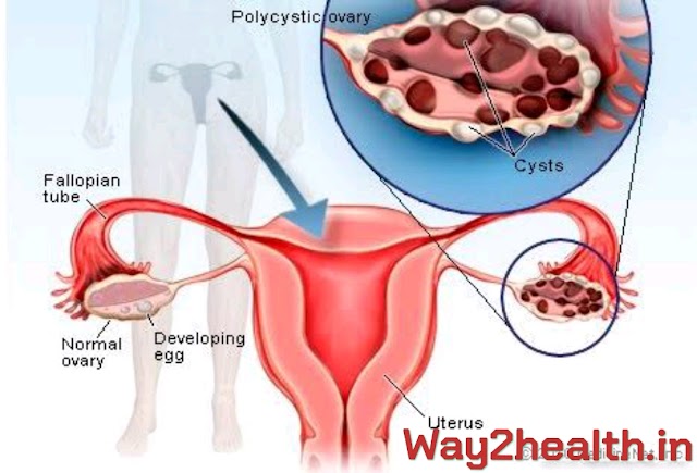  Polycystic Ovarian Syndrome - Diet and lifestyle for Management of PCOS