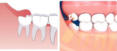 Trường hợp răng khôn mọc ngầm có nên nhổ không? 2