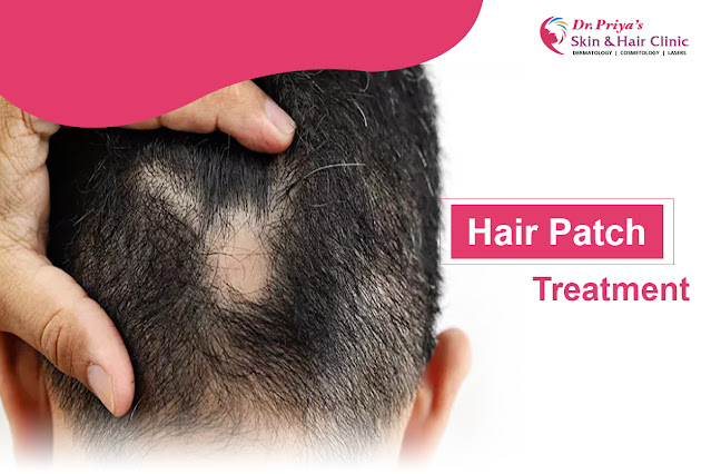 Best Patchy Hair Loss Treatment In Marathahalli