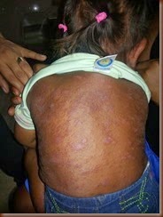 Dermatitis.