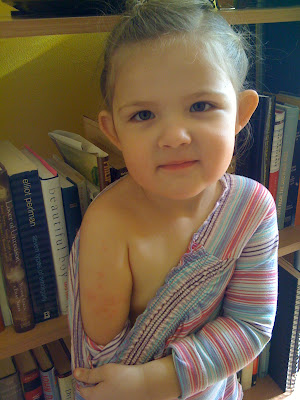 heat rash pictures in toddlers. We thought it was a heat rash,