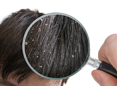 Image illustrating dandruff in hair, emphasizing the need for Ayurvedic  natural solutions for Dandruff-free hair