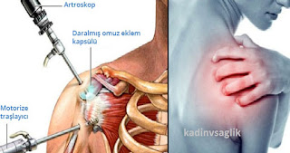 Donuk Omuz Ameliyatı