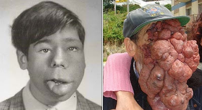 Jose Mestre aged 14, when his tumour was still small (left), and as he is now