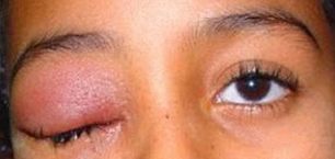 Penyebab Kelopak Mata Bengkak Dan Mengatasinya MazMuiz