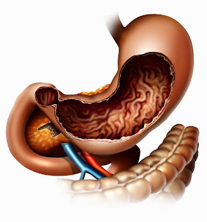 Treatment,Gastroparesis,Gastroparesis treatment