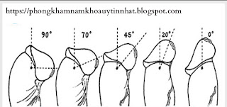 chỉnh hình dương vật bị cong