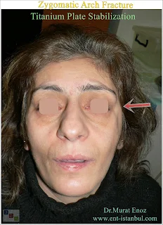 zygomatic arch anatomy, zygomatic arch fracture, titanium plate stabilization, zygomaticomaxillary complex fracture, open reduction and internal fixation, facial trauma, zygomatic fracture treatment, masseter muscle, rigid fixation, biocompatibility, comminuted fracture,