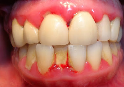 Ảnh hưởng của viêm nướu răng ở bà bầu