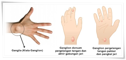 Cara Menyembuhkan Ganglia (Kista Ganglion)