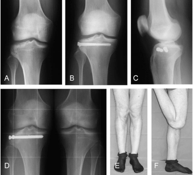 Best Schatzker Fracture Treatment  Surgery