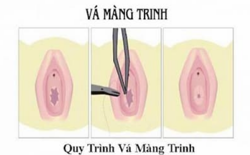 Bạn muốn biết quy trình và chi phí vá màng trinh hiện đại?