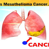 What is the Mesothelioma?