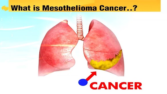 What is the Mesothelioma?