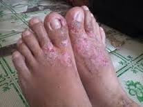 obat penyakit eksim menahun di kaki paling ampuh