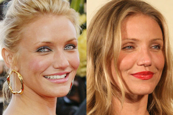 blake lively nose job before and after. efore and after nose job