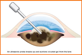 cataract laser surgery in Ashram Road,
