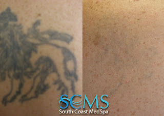 tattoo removal pictures