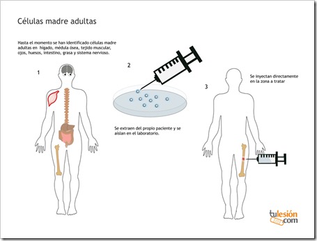 Tratamiento con Células Madre Adultas para recuperar lesiones deportivas.