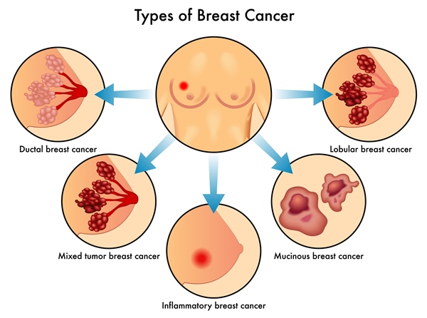 Breast Cancer types